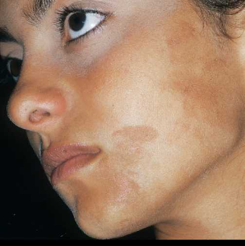 Пигментация кожи на лице фото