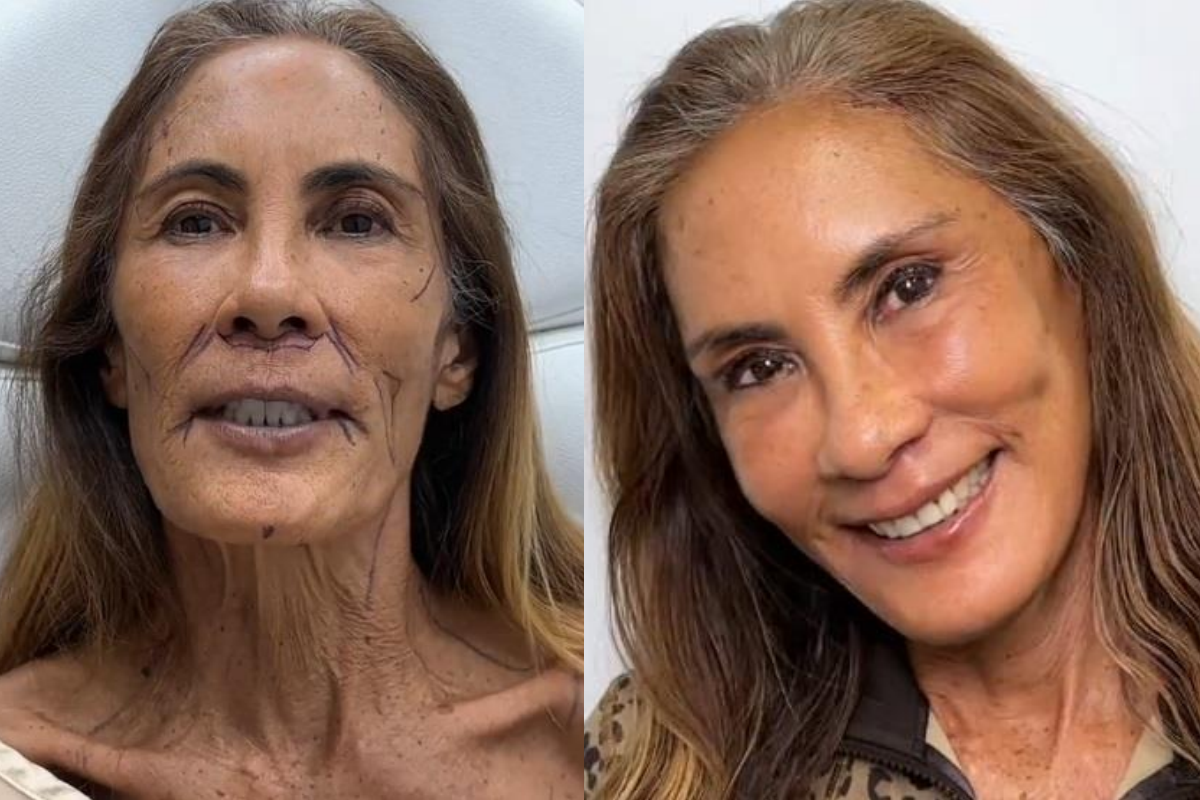 жена пластика лице