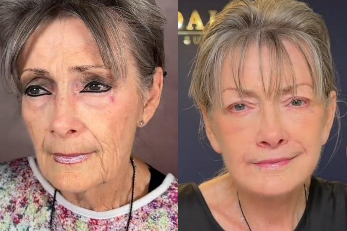 преди и след пластика