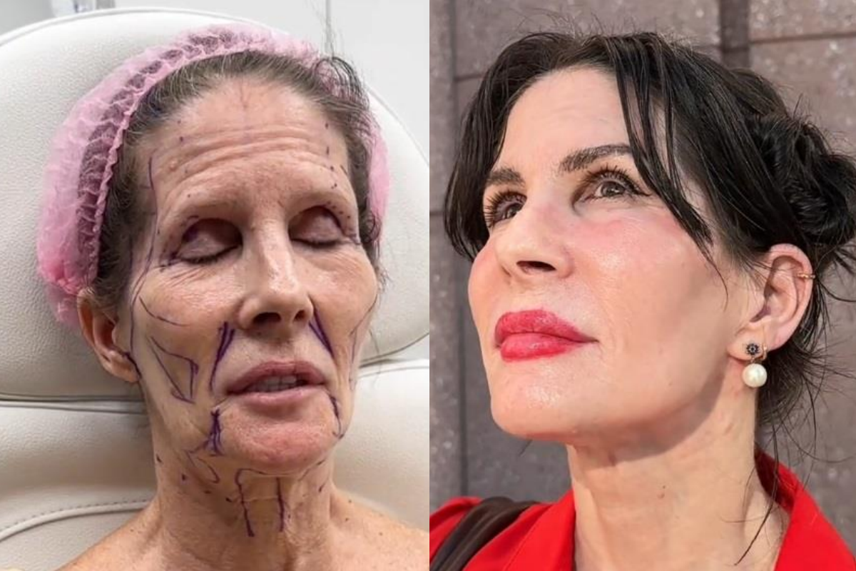 резултат фейслифт