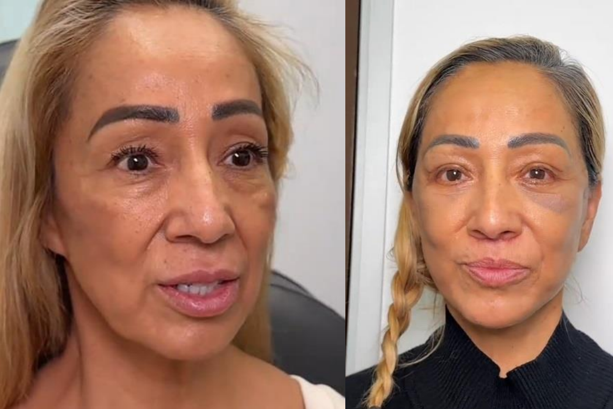 лифтинг лице