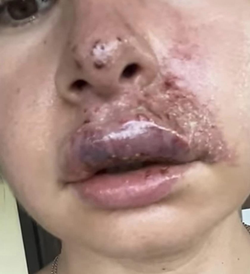 жена некроза