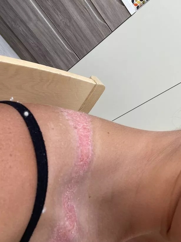  евтини облекла изгаряния 