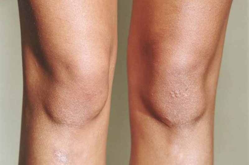 кожата на коленете