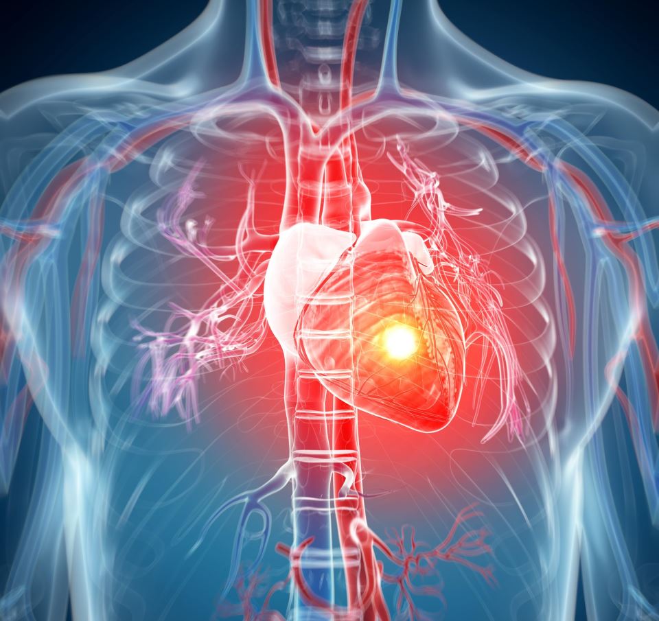 сърдечен удар