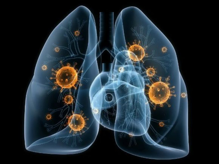 пневмония дробове