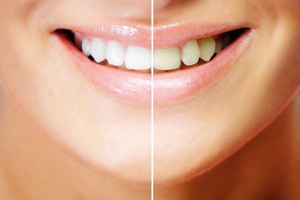 бели зъби преди и след