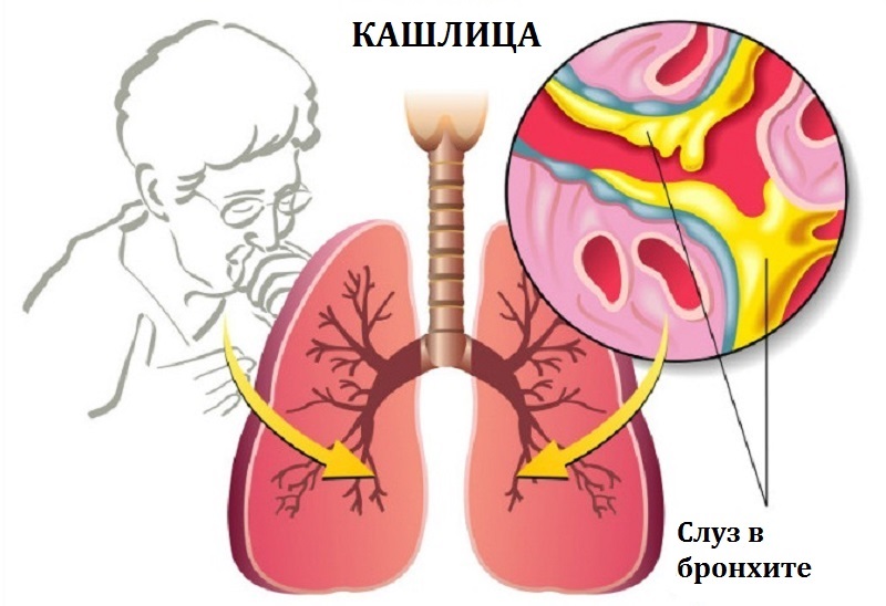 Как да изкараме храчките от белите дробове