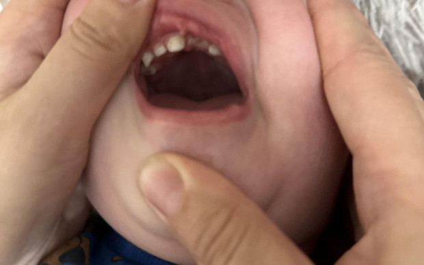 дете избит зъб
