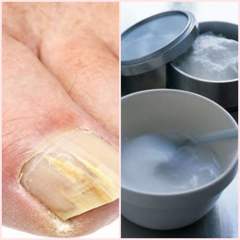  сода гъбички 