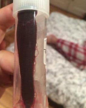 пиявица в носа