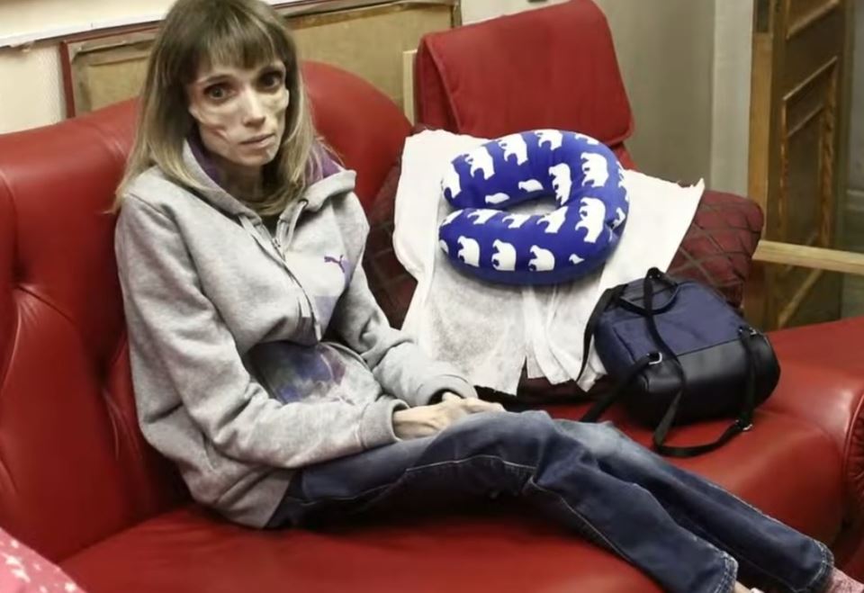 млада жена анорексия