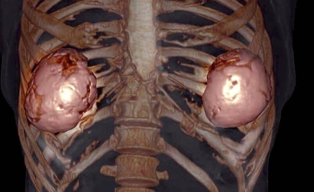 гръдни импланти