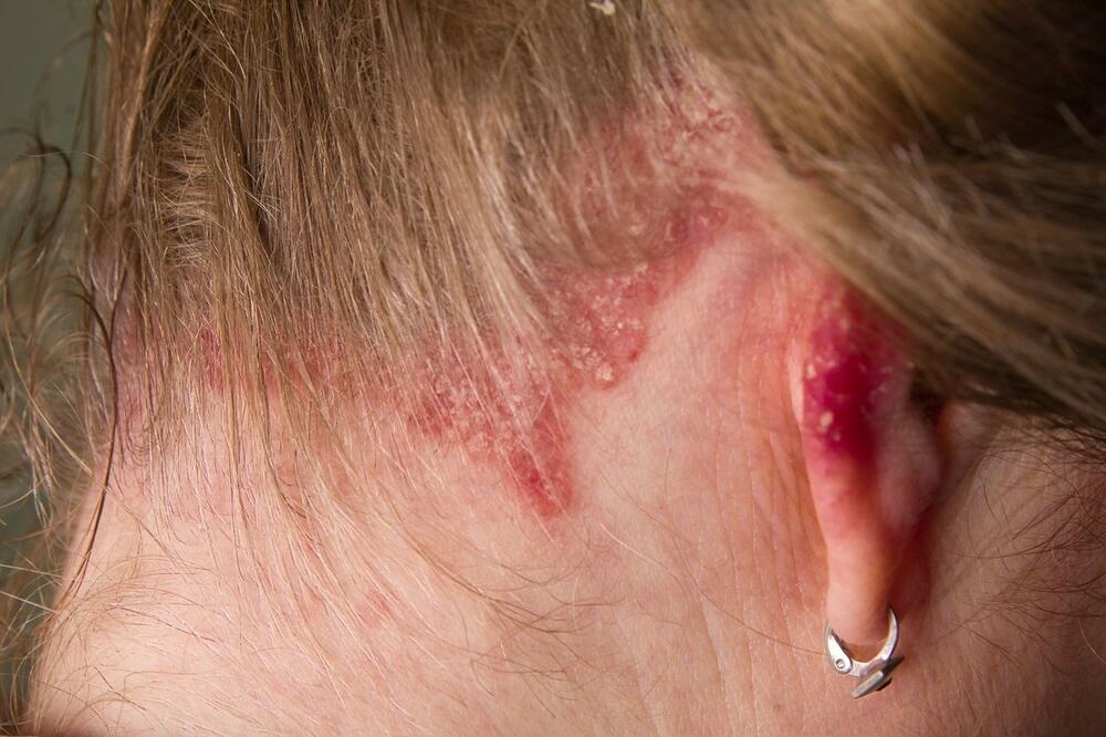 лишеи по кожата