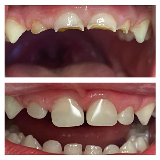 увредени зъби