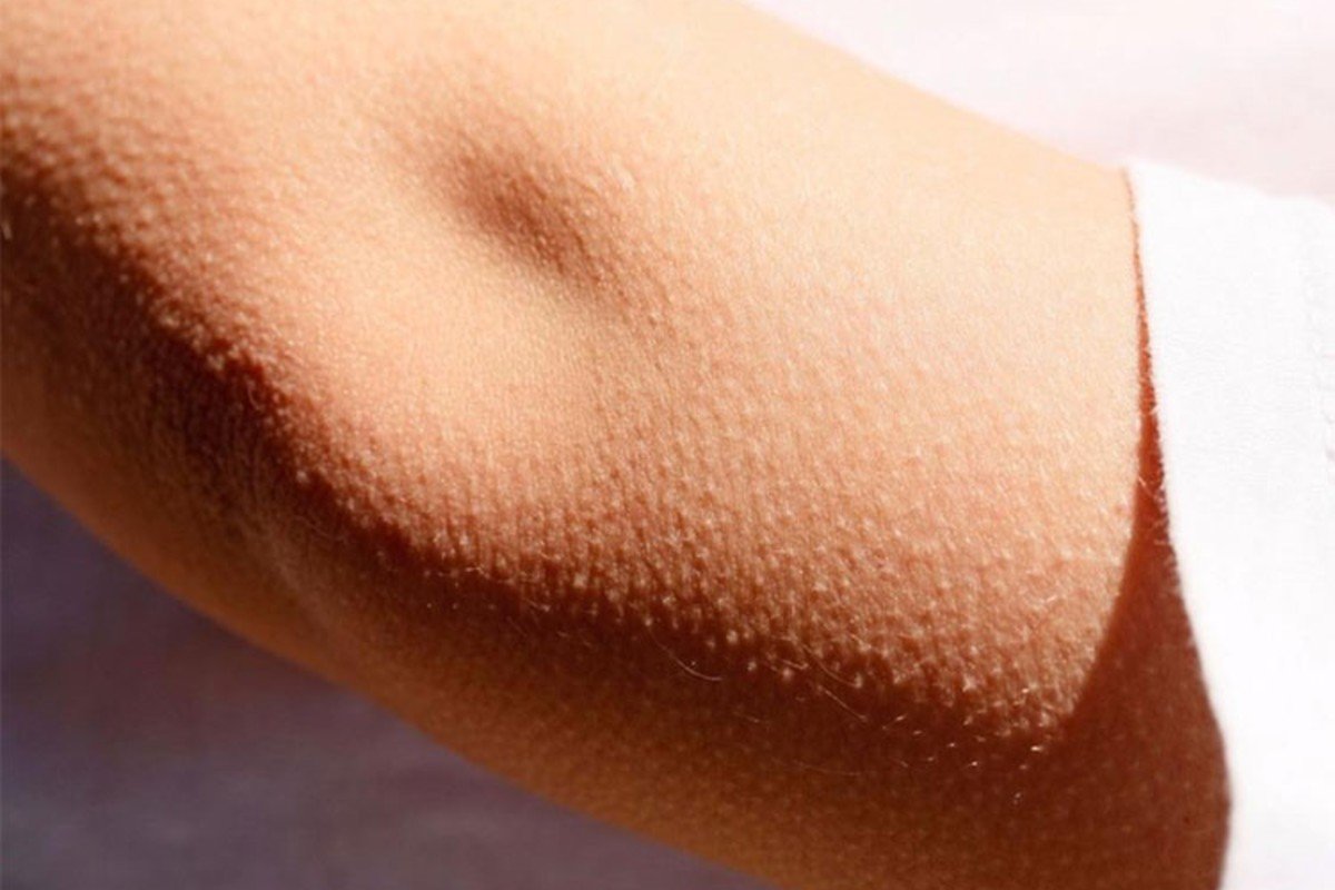 Почему мурашки по ногам. Фолликулярный гиперкератоз гусиная кожа. Фолликулярный кератоз («гусиная. Фолликулярный кератоз гусиная кожа.
