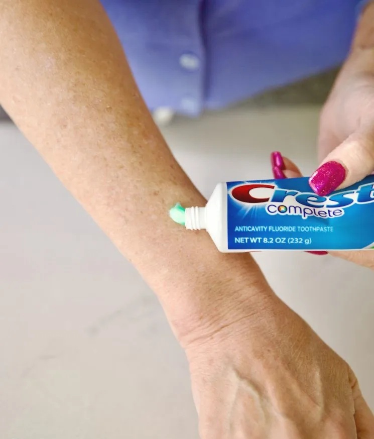 toothpaste for mosquito bites