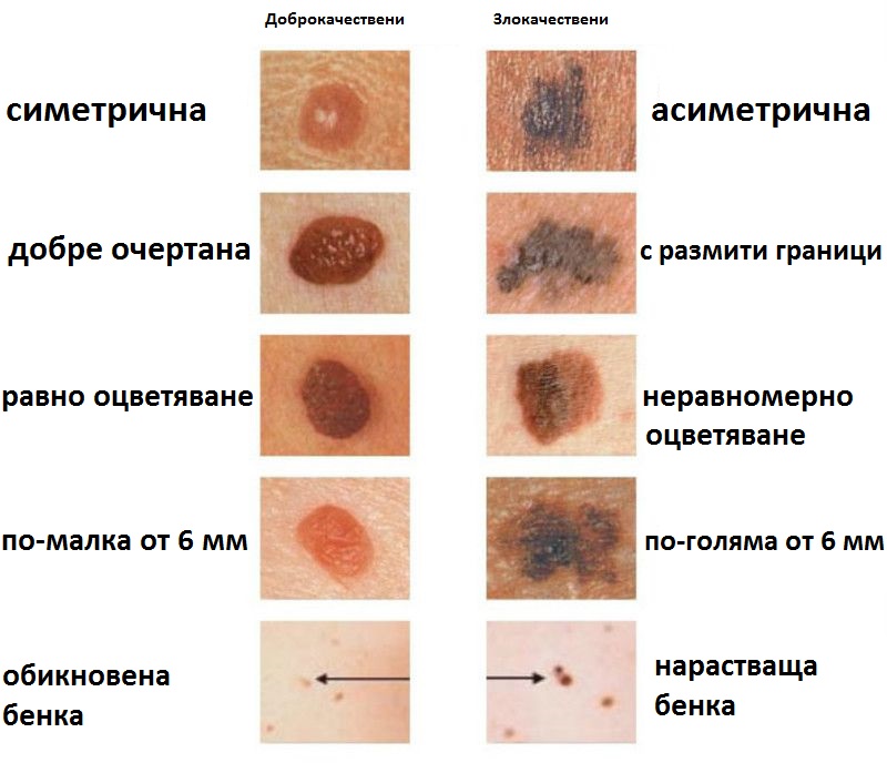 видове рак на кожата снимки