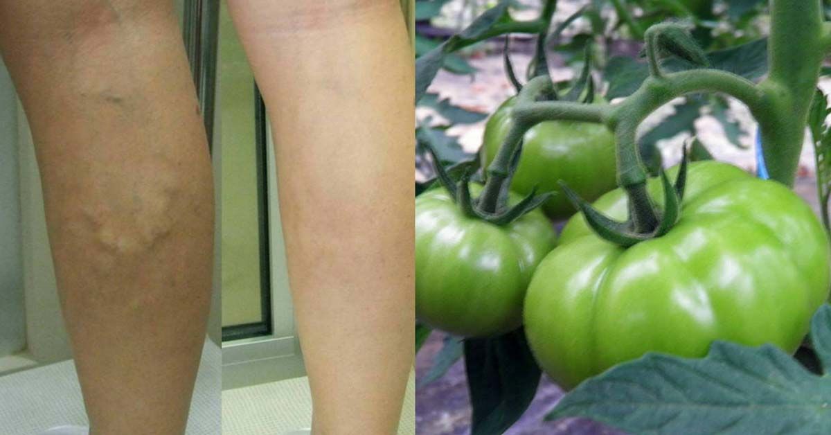 зелени домати при разширени вени