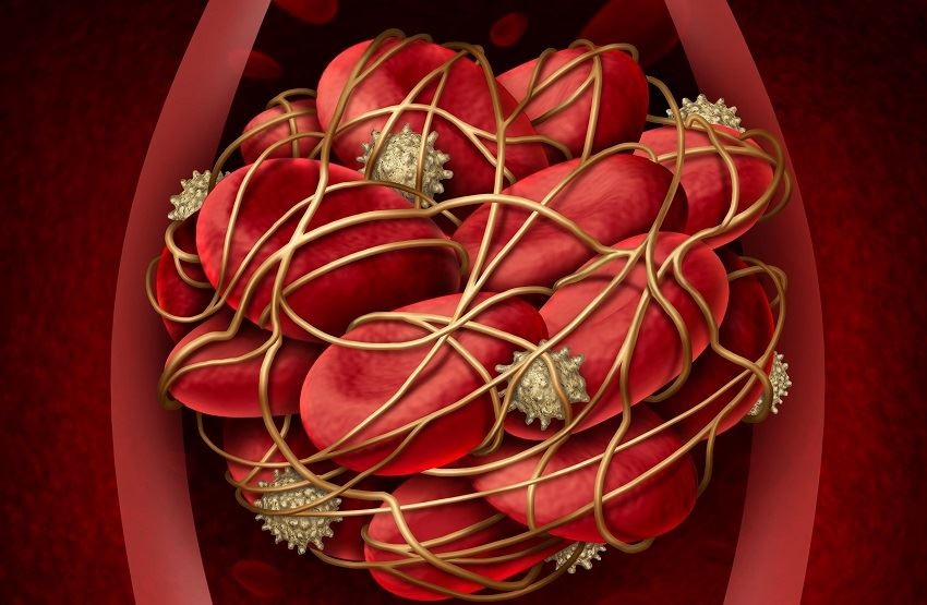 образуване тромб