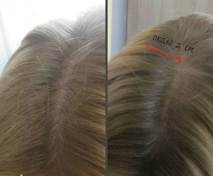 растеж на косата