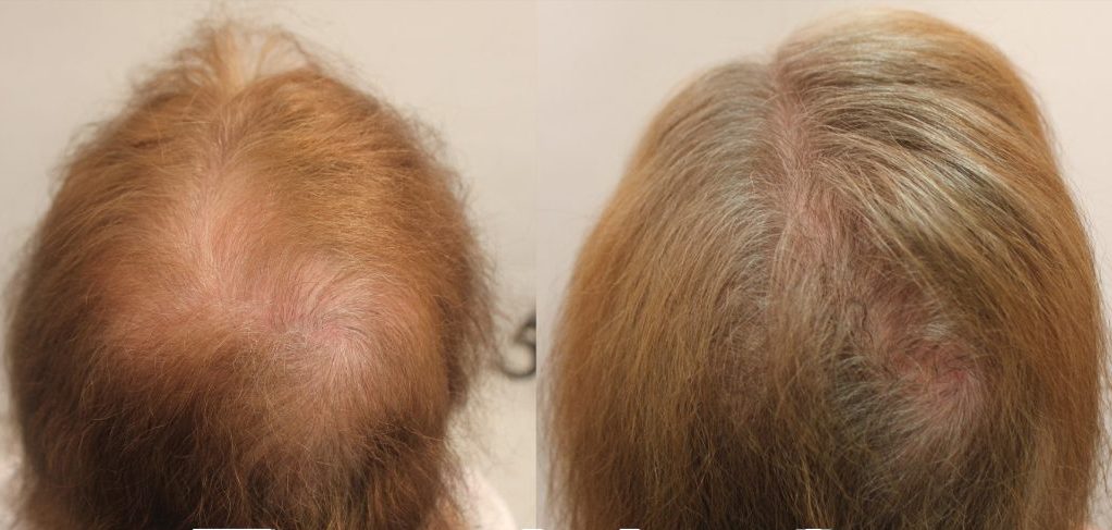 лечение плешивост