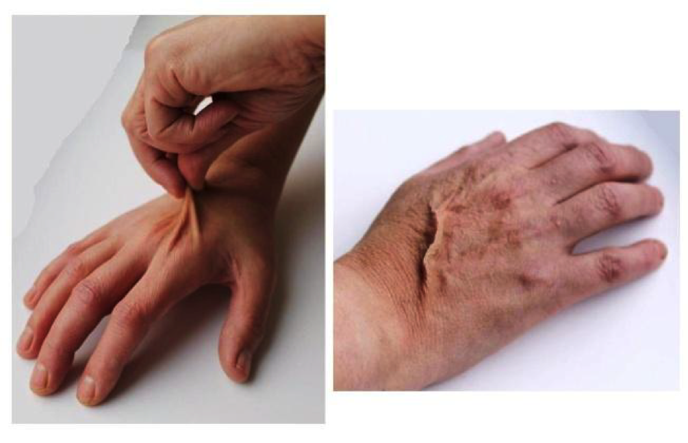 дехидратирана кожа