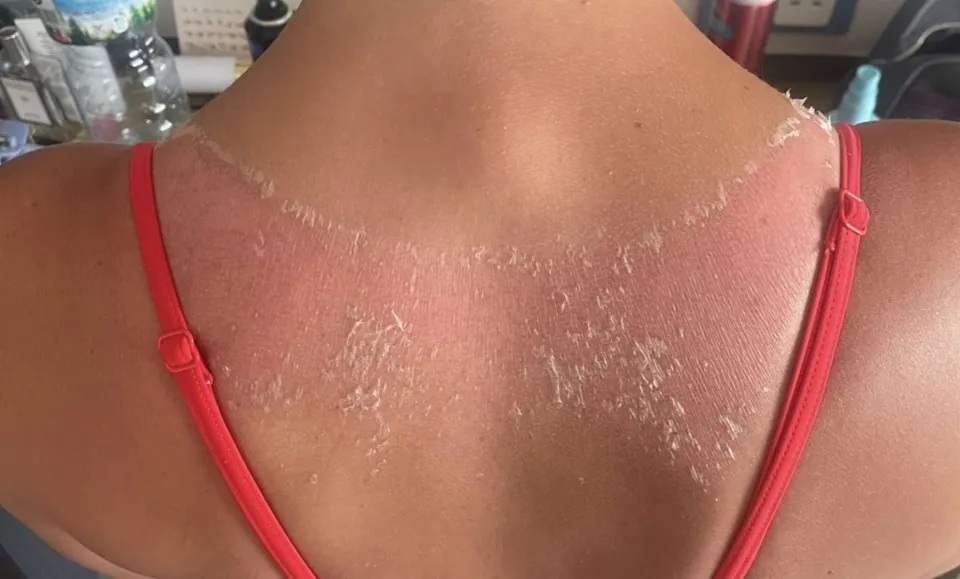  жена изгаряния плещи 