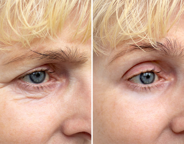Skin effect
