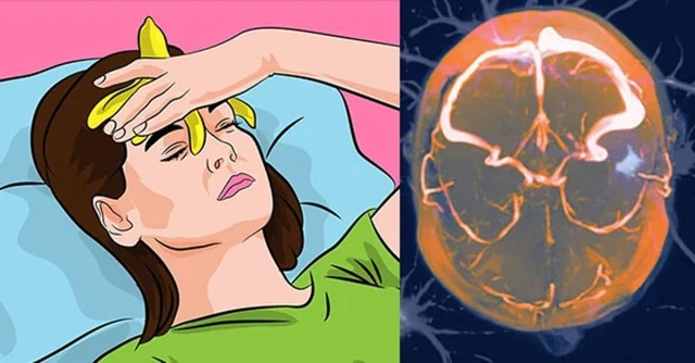 бананова кора главоболие