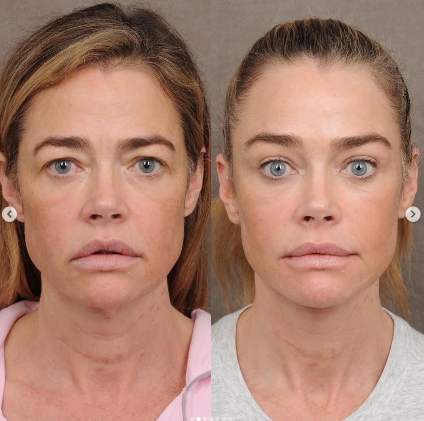 Дениз Ричардс подмладяване