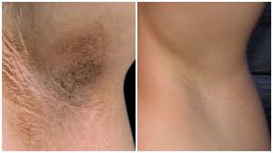  тъмни подмишници 