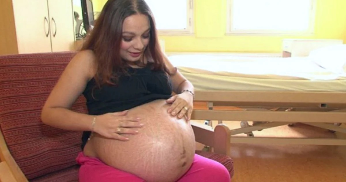 бременна жена стрии