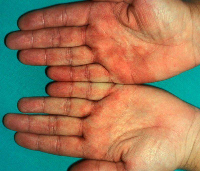  зачервяване на дланите цироза 