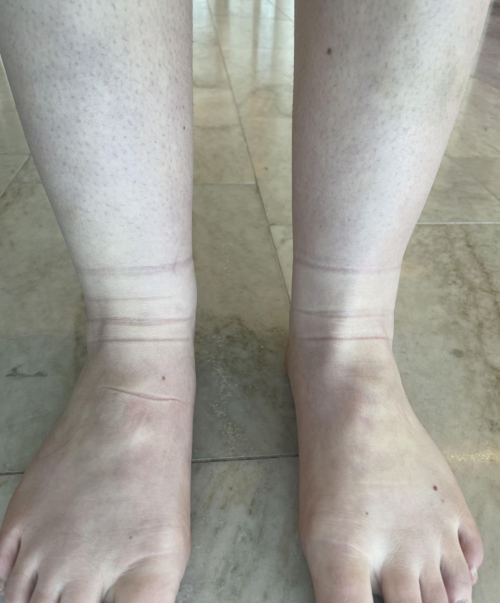 следи от чорапи