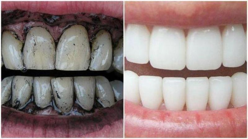 избелване на зъби с въглен
