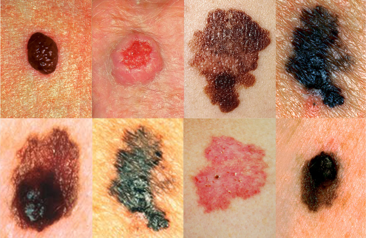 Симптоми на рак на кожата