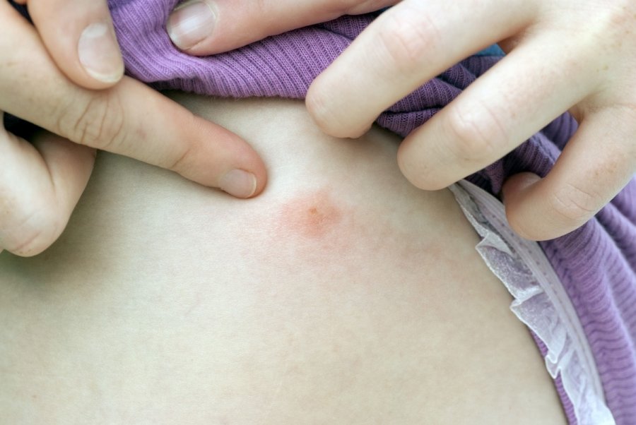  захапване от комар 